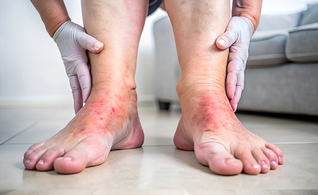 Compression Stockings for Edema
