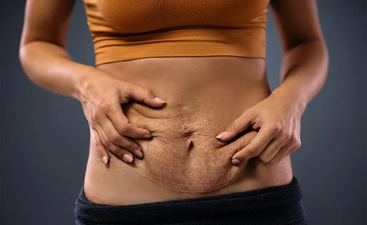 7 Incredibly Useful Tips for Tightening Loose Skin After Giving Birth