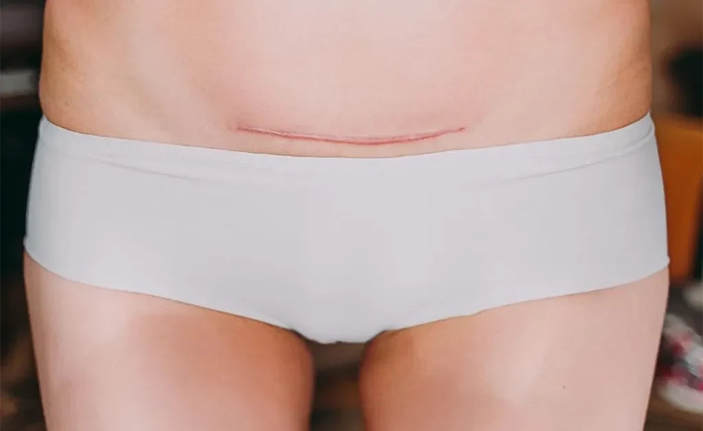 Benefits of Wearing Abdominal Binder after C-section