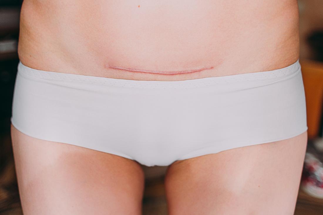 Benefits of Wearing Abdominal Binder after C-section