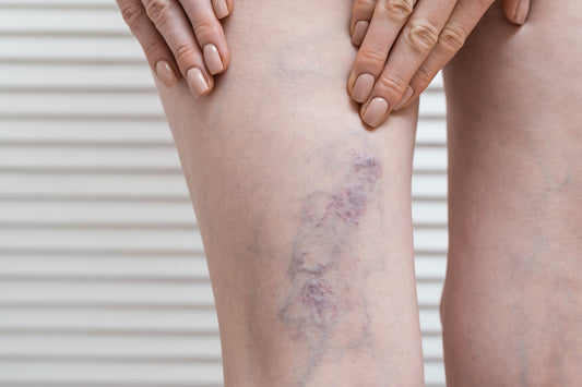 Comfort Meets Circulation: Compression Stockings for DVT Prevention