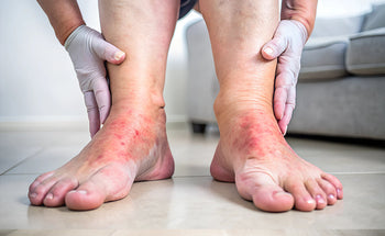 Compression Stockings for Edema: Benefits and Types – SNUG360