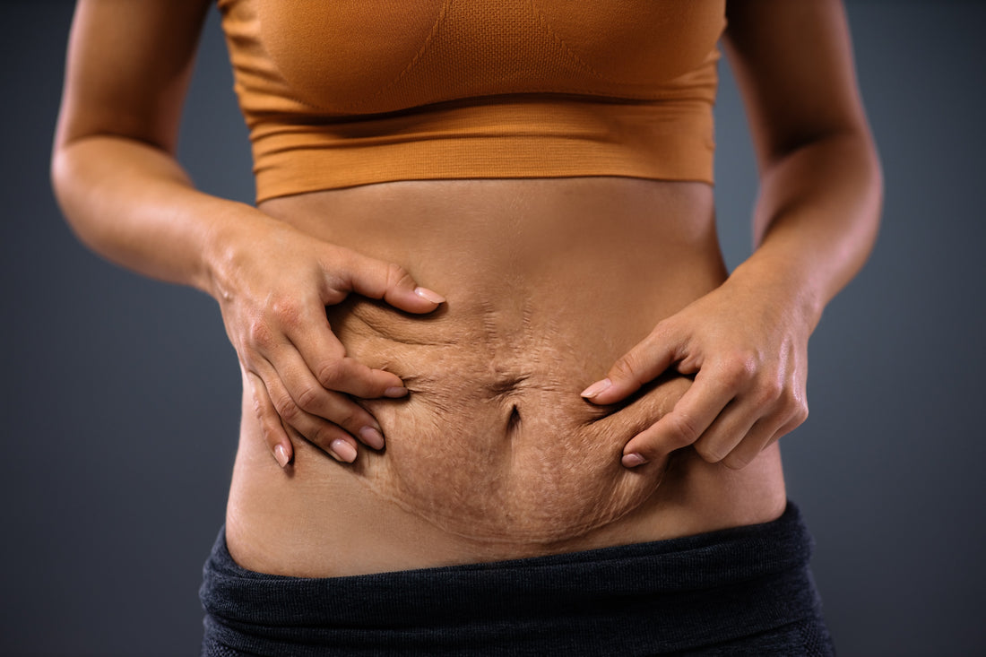 Loose Skin After Giving Birth